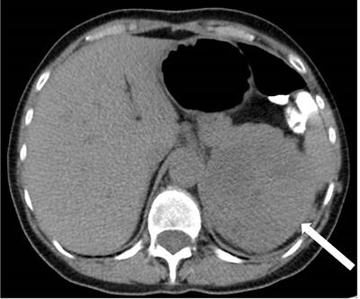 Complete Remission of Advanced Adrenocortical Cancer Following Mitotane Monotherapy: A Case Report and Literature Review of Predictive Markers